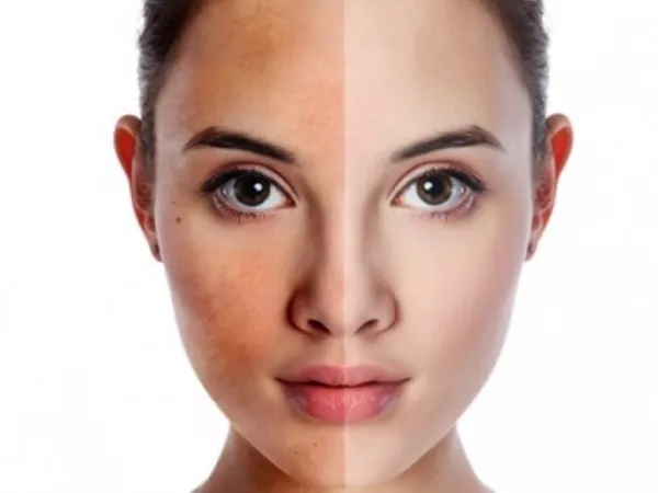 Những lưu ý quan trọng trên hành trình đến làn da trắng sáng