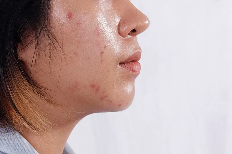 Hiểu đúng về làn da dầu: Không chỉ là "bóng loáng"!