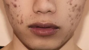 Mỹ phẩm thiên nhiên giúp giảm vết thâm