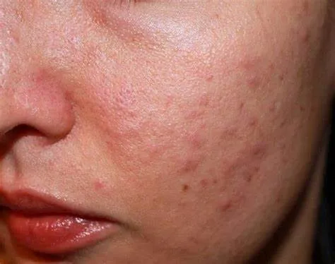 Những lưu ý quan trọng khi chăm sóc da viêm