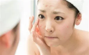 Mỹ phẩm thiên nhiên cho da mặt bị mụn