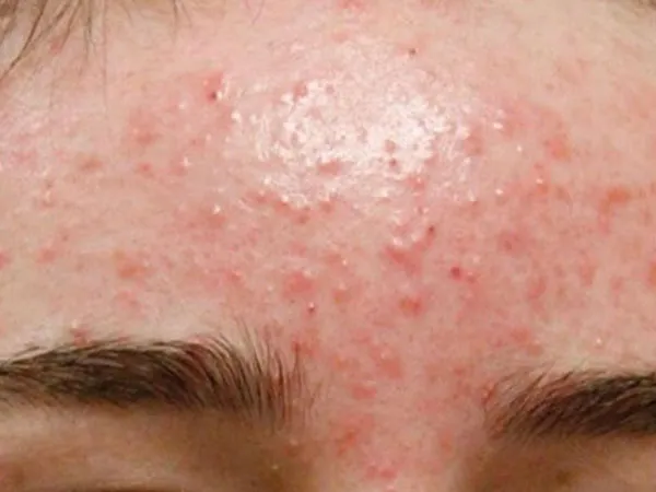 Mụn trứng cá - Vấn đề da phổ biến và nguyên nhân "gốc rễ"