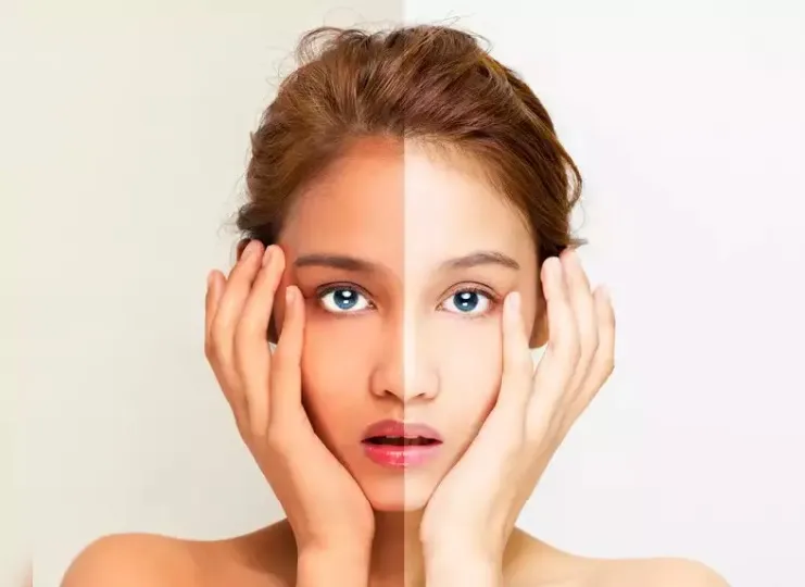 Cần làm gì ngay khi phát hiện da bị cháy nắng?