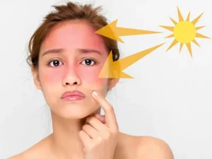 Mỹ phẩm thiên nhiên cho da bị cháy nắng