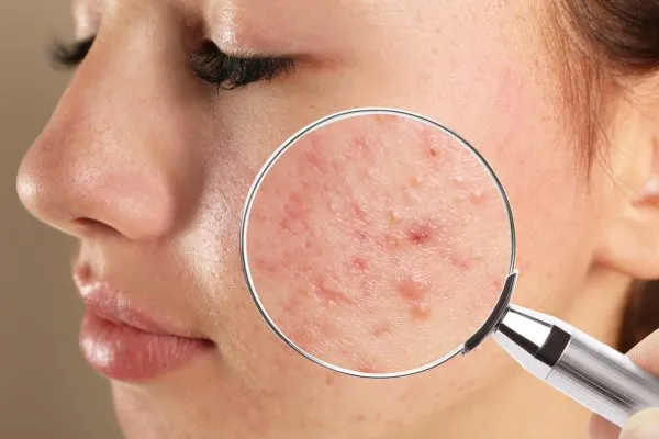Các thành phần "nhạy cảm" cần tránh xa khi da bị mụn