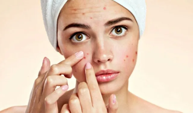 Hiểu về mụn trứng cá: Nguyên nhân và những "thủ phạm" gây mụn
