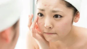 Mỹ phẩm thiên nhiên cho da bị mụn trứng cá