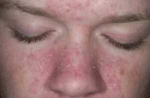 Mỹ phẩm thiên nhiên giúp chống viêm da